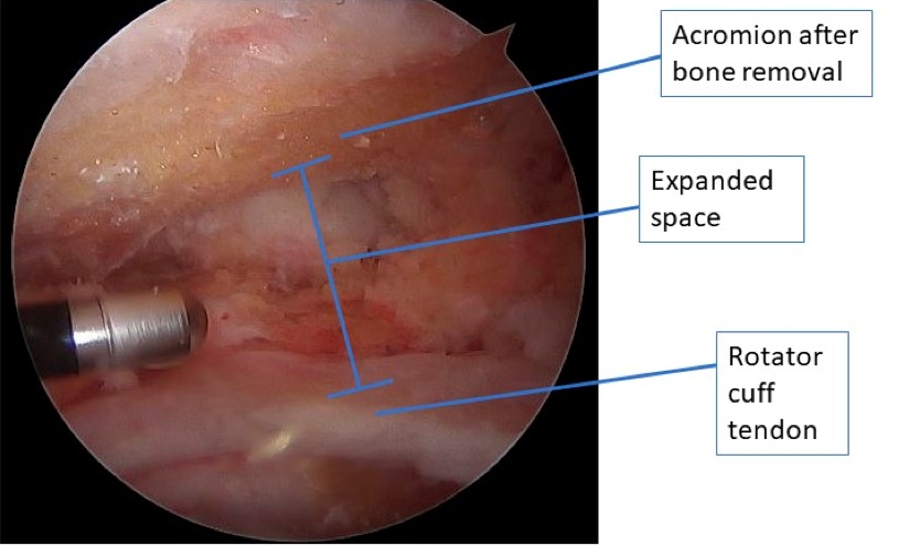 acromioplasty labeled